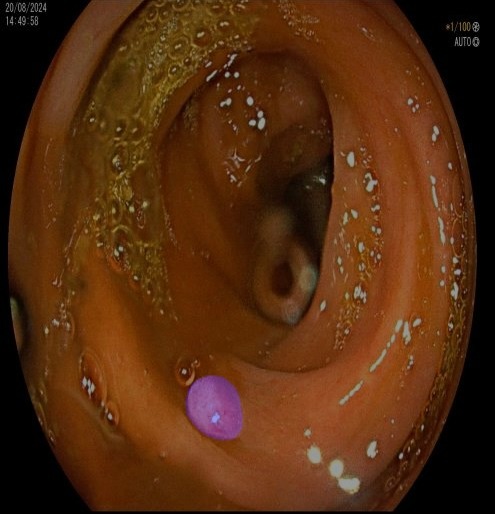 Polyp Detection