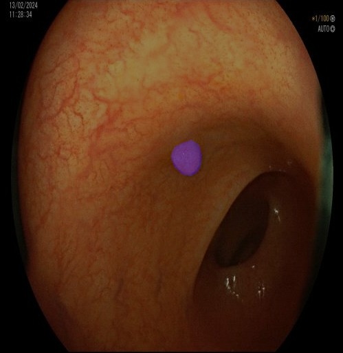 Polyp Detection